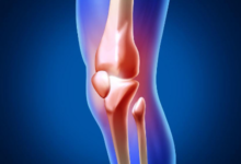 退化性关节炎造成原因?退化性关节炎有哪些症状?如何预防与改善退化性关节炎-LaMaHT辣妈海淘